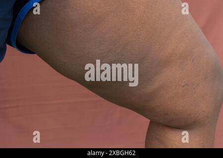 Intérieur foncé de la cuisse sur peau brune, hyperpigmentation et assombrissement de l'intérieur de la cuisse sur peau brune Banque D'Images