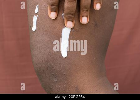 Lotion sur peau brune avec eczéma, application de lotion sur dermatite atopique et prurigo nodularis sur peau brune jambe, application de pommade sur eczéma breakou Banque D'Images