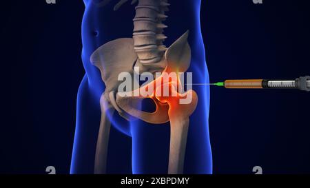 Anatomie traitement de l'articulation de la hanche humaine Banque D'Images