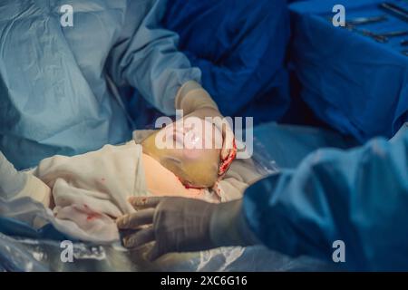 Un bébé est accouché dans un sac amniotique intact pendant une césarienne. L'équipe médicale effectue soigneusement la procédure, en mettant en évidence le Banque D'Images