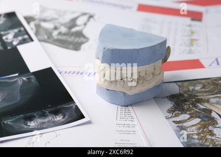 Modèle dentaire avec gencives, cartes anatomiques et radiographie panoramique. Fonte de dents Banque D'Images
