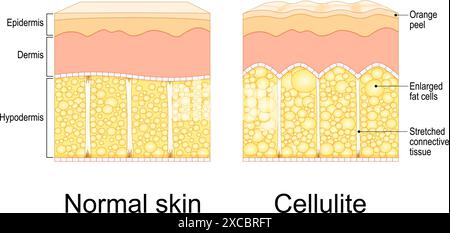 Formation de cellulite. Syndrome de la peau d'orange. Adipose oedémateuse. Section transversale de cellulite et une peau saine. Anatomie cutanée. Tissu adipeux du corps humain. V Illustration de Vecteur