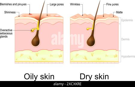 Peau grasse et sèche. Types de peau. Coupe transversale d'une peau humaine avec rides, pores, imperfections et boutons, cheveux et glandes sébacées. Affiche vectorielle Illustration de Vecteur