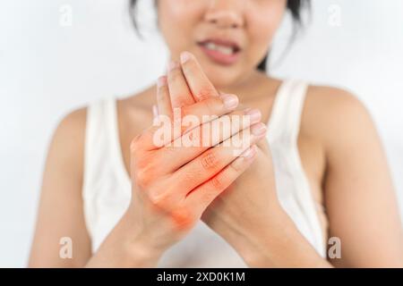 Une femme aux mains rouges et au visage rouge. Elle tient ses mains ensemble. La scène est celle de l'inconfort et de la douleur Banque D'Images