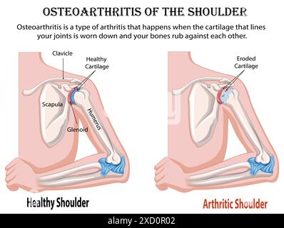 Diagramme sain de l'articulation arthritique de l'épaule de VS sur fond blanc Illustration de Vecteur