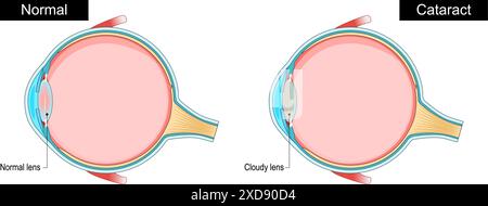 Cataracte. Coupe transversale d'un œil humain avec lentille normale et lentille nuageuse. Vision floue. Santé oculaire. Processus de vieillissement dans l'oeil. Diminution de la vision. Vecteur Illustration de Vecteur