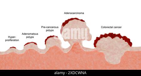 Illustration des stades du développement tumoral du cancer colorectal. L'hyperprolifération, les polypes adénomateux et les polypes précancéreux sont tous des croissances anormales de cellules dans la muqueuse du côlon ou du rectum qui sont généralement bénignes. Cependant, si ces excroissances ne sont pas traitées, il y a une chance qu'elles deviennent malignes et se développent en cancer colorectal. L'adénocarcinome et le cancer colorectal décrivent les stades malins de ces excroissances. Les polypes peuvent être enlevés chirurgicalement pour les empêcher de se développer en cancer. Banque D'Images