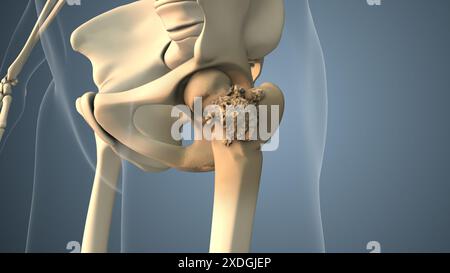 Cancer se propageant le long d'un os de la hanche Banque D'Images