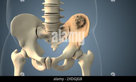 Cancer se propageant le long d'un os pelvien Banque D'Images