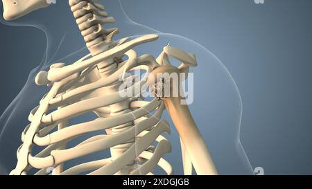 Cancer se propageant le long d'un os de l'épaule Banque D'Images