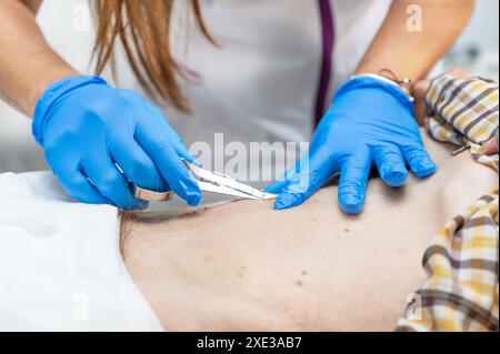 Infirmière enlevant des points de suture chirurgicaux de l'abdomen d'un patient après intervention chirurgicale. Banque D'Images