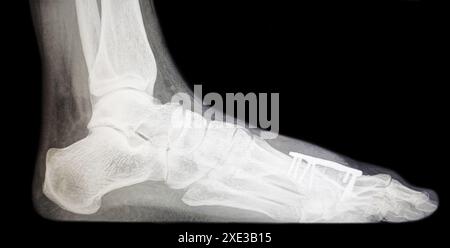 Radiographie d'arthrodèse par distraction par bloc osseux - MTP1 de l'articulation métatarsophalangienne hallux Banque D'Images