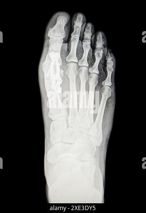 Radiographie d'arthrodèse par distraction par bloc osseux - MTP1 de l'articulation métatarsophalangienne hallux Banque D'Images