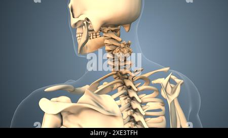 Cancer se propageant le long d'un os du cou ou d'une colonne vertébrale Banque D'Images
