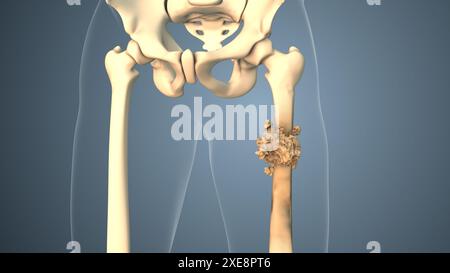 Cancer se propageant le long d'un os de cuisse Banque D'Images