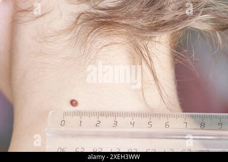 Femme examinant sa taupe anormale. Procédé dermatologique. Médecin examinant le mélanome du cancer cutané du patient. Verrue foncée au cou de la femme. Vue arrière. Traitement du papillome d'ablation Banque D'Images