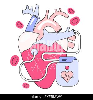 Stimulateur cardiaque artificiel. Dispositif médical qui génère des impulsions électriques délivrées par des électrodes aux cavités du coeur. Illustration vectorielle plate Illustration de Vecteur