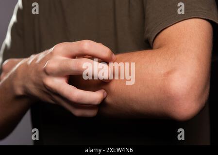 Jeune homme se grattant le bras avec sa main. Maladie de la peau. Irritation, allergie. Isolé sur fond noir. Banque D'Images