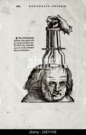 Illustration du XVIe siècle de la chirurgie et des interventions chirurgicales au moyen âge : la trépanation du crâne. D'après les livres médiévaux d'Octavius Horatianus et Abu al-Qasim Khalaf ibn al-Abbas al-Zahrawi. 1532 Banque D'Images