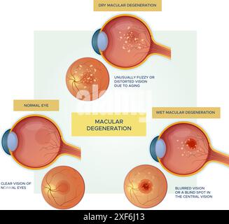 Yeux normaux vs dégénérescence maculaire sèche / humide - illustration stock en tant que fichier EPS 10 Illustration de Vecteur