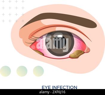 Infection oculaire avec pus jaune ou vert - oeil rose - illustration stock en tant que fichier EPS 10 Illustration de Vecteur