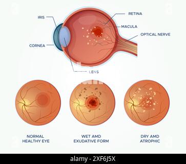 Comprendre la dégénérescence maculaire yeux sains vs humide et SEC AMD - illustration stock en tant que fichier EPS 10 Illustration de Vecteur