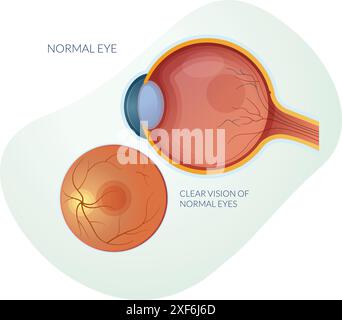 Œil normal sans dégénérescence maculaire sèche ou humide - illustration stock en tant que fichier EPS 10 Illustration de Vecteur