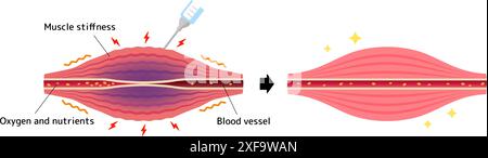 Mécanisme de relaxation musculaire par injection de toxine botulique Illustration de Vecteur