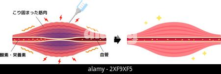 Mécanisme de relaxation musculaire par injection de toxine botulique Illustration de Vecteur