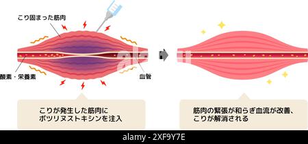 Mécanisme de relaxation musculaire par injection de toxine botulique Illustration de Vecteur