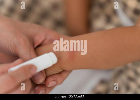 mère appliquant la crème antiallergique sur l'allergie avec tache rouge au bras de bébé après piqûre rouge de moustique Banque D'Images