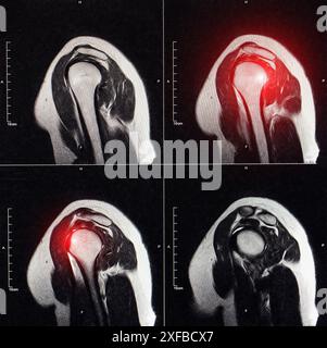 Imagerie IRM de l'articulation de l'épaule après fracture et luxation. Fracture d'empreinte de la tête humérale. Blessure à l'épaule, entorse, synovite. Le rouge Banque D'Images