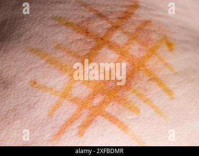 Application d'une maille d'iode au joint après injection intramusculaire du médicament. Traitement des infiltrats post-injection Banque D'Images