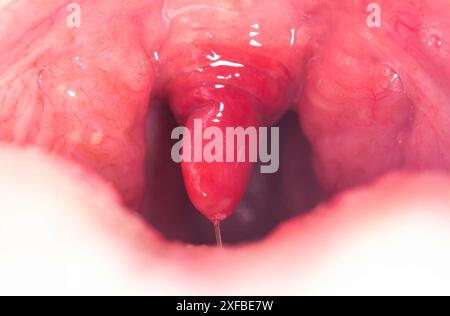 Luette rouge, enflammée et gonflée dans la gorge. Traitement des uvulites à bactéries et à virus streptococciques. Oto-rhino-laryngologie Banque D'Images