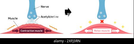 Mécanisme de relaxation musculaire par le botox. Illustration vectorielle. Illustration de Vecteur