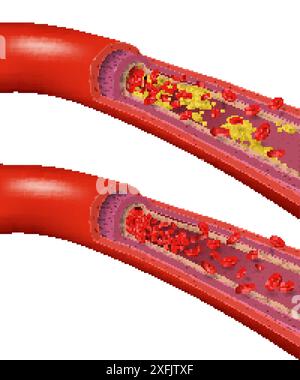 Vaisseaux sanguins sains et bloqués par le cholestérol, concept médical sur fond blanc, illustration vectorielle réaliste Illustration de Vecteur