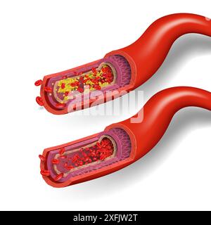 Vaisseaux sanguins sains et bloqués par le cholestérol, concept médical sur fond blanc, illustration vectorielle réaliste en gros plan Illustration de Vecteur