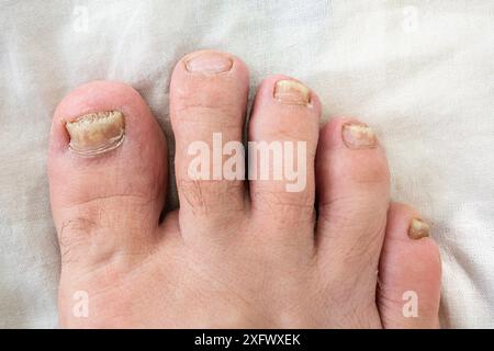 Partie du pied d'un homme avec des ongles affectés par un champignon, vue de dessus. Banque D'Images