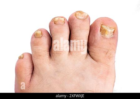 Pied mâle avec des ongles endommagés par un champignon sur un fond blanc isolé, vue de dessus. Banque D'Images