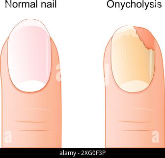 Onycholyse. Comparaison et différence entre un ongle sain et le décollement de la plaque de l'ongle du lit de l'ongle. La santé des ongles. Illustration vectorielle Illustration de Vecteur