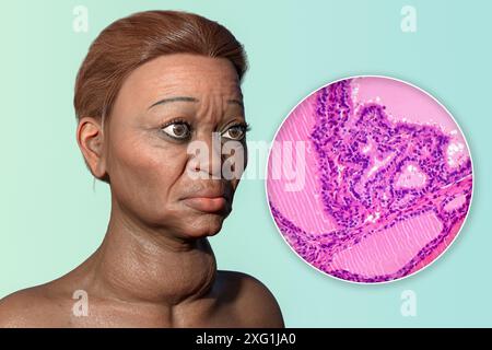 Illustration d'une femme atteinte de la maladie de Basedow et un gros plan du tissu thyroïdien affecté. La maladie de Basedow peut provoquer le développement d'une glande thyroïde élargie (goitre, base du cou) et peut provoquer une protrusion anormale des yeux (exophtalmie). La maladie de Basedow est une maladie auto-immune dans laquelle des anticorps sont produits qui provoquent la production excessive d'hormones par la glande thyroïde. Banque D'Images