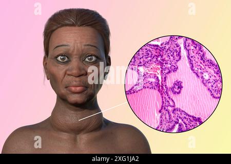 Illustration d'une femme atteinte de la maladie de Basedow et un gros plan du tissu thyroïdien affecté. La maladie de Basedow peut provoquer le développement d'une glande thyroïde élargie (goitre, base du cou) et peut provoquer une protrusion anormale des yeux (exophtalmie). La maladie de Basedow est une maladie auto-immune dans laquelle des anticorps sont produits qui provoquent la production excessive d'hormones par la glande thyroïde. Banque D'Images