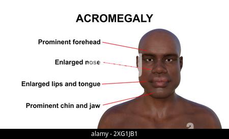 Illustration d'un homme atteint d'acromégalie avec des symptômes typiques étiquetés. C'est une condition provoquant une augmentation de la taille des mains et du visage due à la surproduction de somatotrophine (hormone de croissance humaine). Elle résulte généralement de la formation d'une tumeur bénigne (adénome) sur l'hypophyse. Banque D'Images