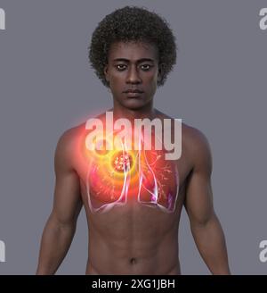 Illustration d'une cavité thoracique (thorax) d'un homme révélant un complexe de Ranke (jaune/orange) dans les poumons d'origine tuberculeuse. Un complexe de Ranke est une lésion dans les poumons composée de ganglions lymphatiques gonflés et de bactéries (complexe de Ghon) qui est devenue calcifiée et durcie. La tuberculose est une infection bactérienne des poumons. Elle peut être grave si elle n'est pas traitée, mais les antibiotiques résolvent généralement l'infection. Banque D'Images