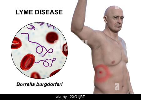 Illustration montrant un érythème migrant, une éruption cutanée caractéristique observée chez des patients atteints de la maladie de Lyme, et un gros plan de la bactérie Borrelia burgdorferi responsable. Cette bactérie est généralement transférée à l'homme par l'intermédiaire d'un vecteur d'insecte, comme une tique. Banque D'Images