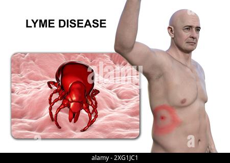 Illustration montrant un érythème migrant, une éruption cutanée caractéristique observée chez des patients atteints de la maladie de Lyme et un gros plan d’une tique. La maladie de Lyme est causée par la bactérie Borrelia burgdorferi. Elle est généralement transférée à l'homme par l'intermédiaire d'un insecte vecteur, les tiques étant les plus courantes. Banque D'Images