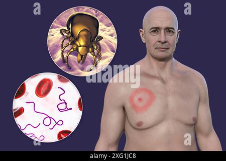 Illustration montrant un érythème migrant, une éruption cutanée caractéristique observée chez des patients atteints de la maladie de Lyme. La bactérie responsable Borrelia burgdorferi et le vecteur typique de tique sont tous deux montrés en gros plan. Banque D'Images