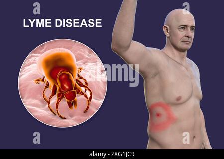 Illustration montrant un érythème migrant, une éruption cutanée caractéristique observée chez des patients atteints de la maladie de Lyme et un gros plan d’une tique. La maladie de Lyme est causée par la bactérie Borrelia burgdorferi. Elle est généralement transférée à l'homme par l'intermédiaire d'un insecte vecteur, les tiques étant les plus courantes. Banque D'Images