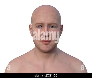 Illustration d'un homme atteint d'ésotropie montrant un mauvais alignement de l'oeil vers l'intérieur. Banque D'Images