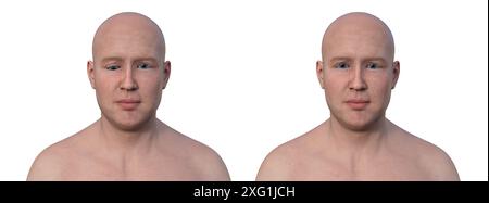 Illustration d'un homme hypotropique montrant un mauvais alignement des yeux vers le bas (à gauche) à côté du même homme en bonne santé (à droite). Banque D'Images